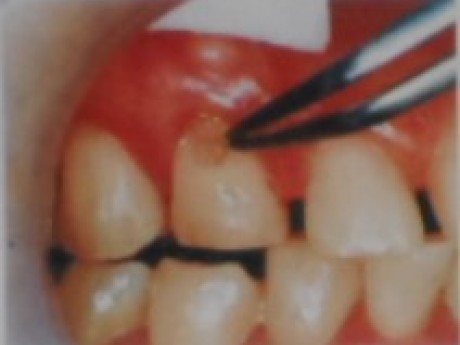 充分涂抹牙质粘合用处理剂后，放置20秒