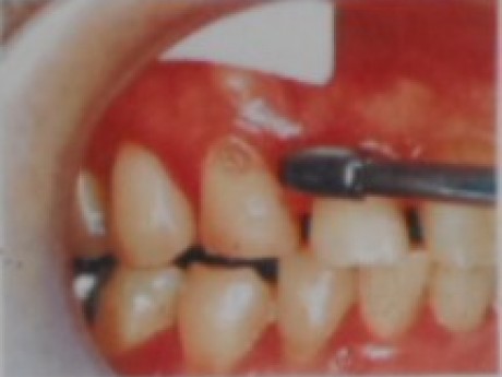 干燥牙质粘合用处理剂