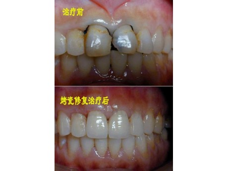口腔修复
